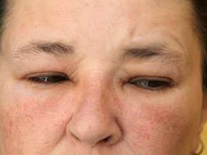 Puffy eyes: How to get rid of puffy eyes - All About Vision